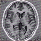 MRI検査画像例